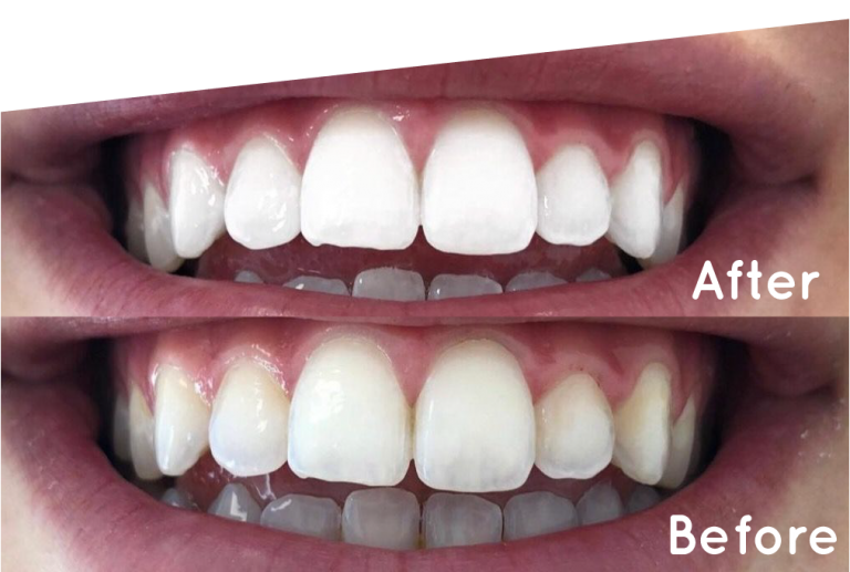 Whitening Maintenance Programs