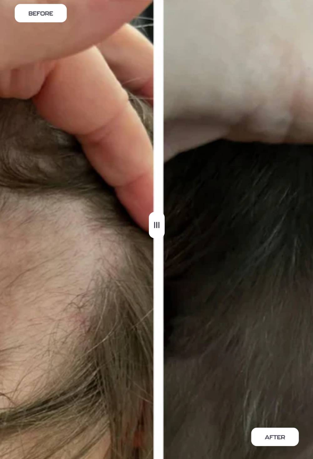 Boombae Hair Salon Manchester and Dublin | The Rising Tide of Hair Loss: What’s Really Going On