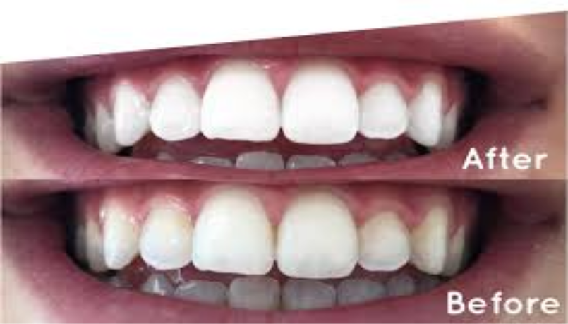 Boombae Hair Salon Manchester and Dublin | Is Teeth Whitening Dublin Safe? Expert Guide from Boombae