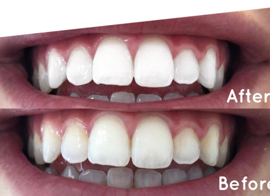 Whitening Maintenance Programs